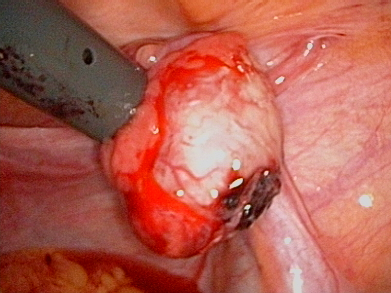 corpus luteum bleeding point